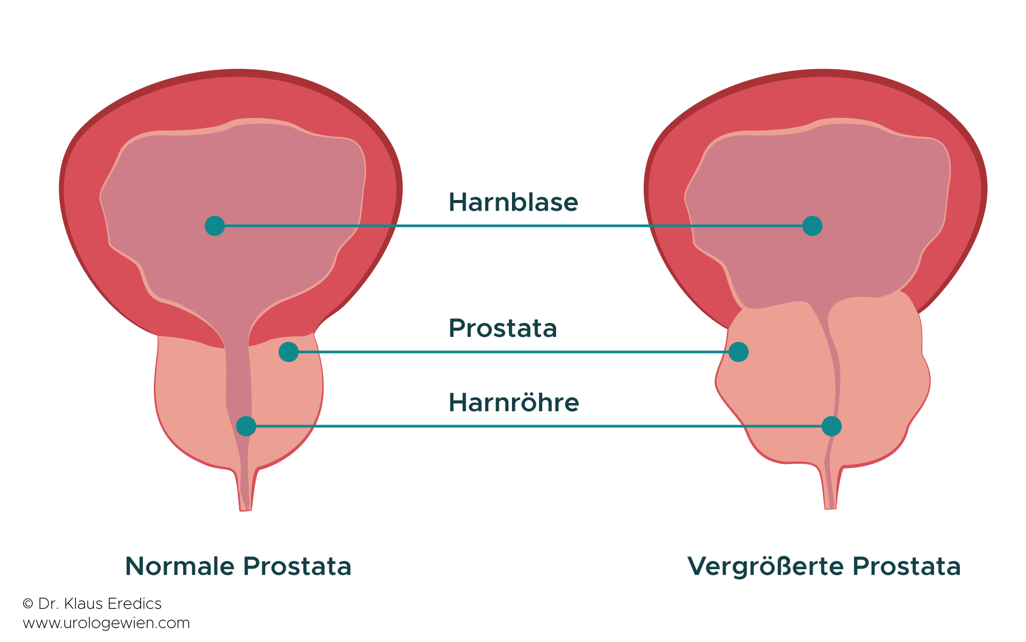 Prostata Vergrößerung Urologe Wien Dr Klaus Eredics